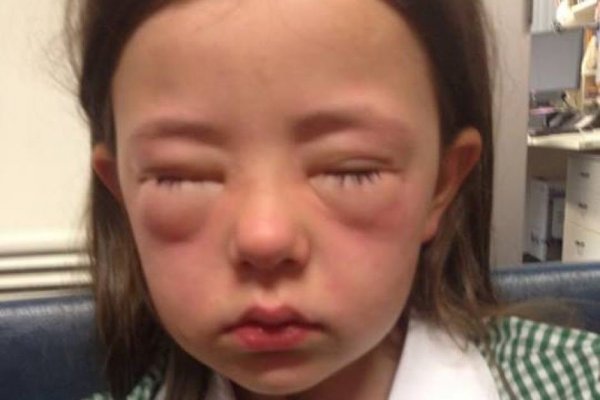 Anafilaxiás reakció - súlyos allergia! Fotó: www.abc.net.au